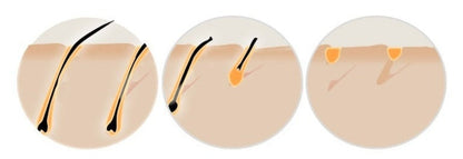At-Home IPL Laser Hair Removal Device | Safe, Permanent & Painless